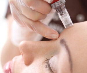 Microneedling