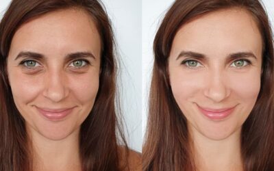 Reveal Smoother Skin with OPUS Plasma Resurfacing
