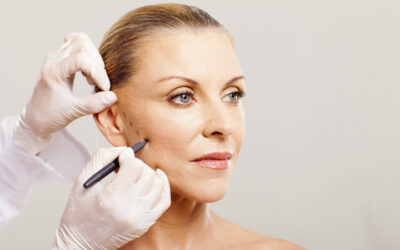 Facial Fillers In Women In Their 50s