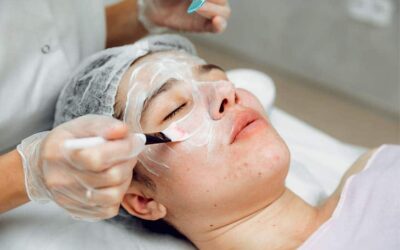 Best Chemical Peel for Acne Scars and Dark Spots